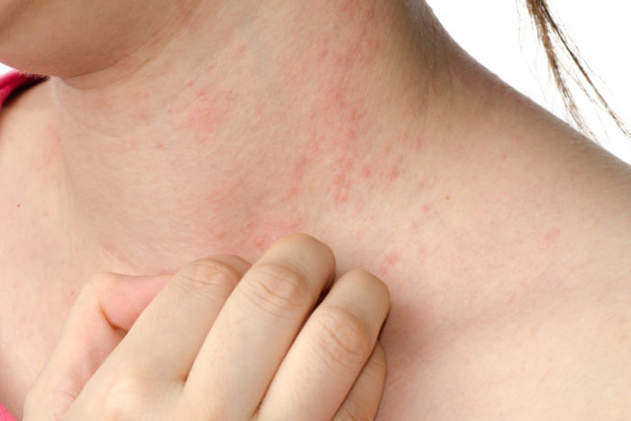 Eczema and Dermatitis Treatment