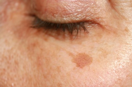 Treating Benign Pigmented Lesions