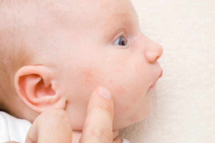 Treating newborn breakouts, spots and acne