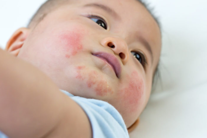 Treating newborn eczema, dermatitis and other rashes
