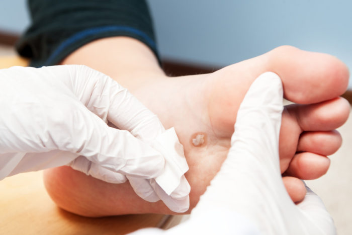 Treating newborn warts and verrucas